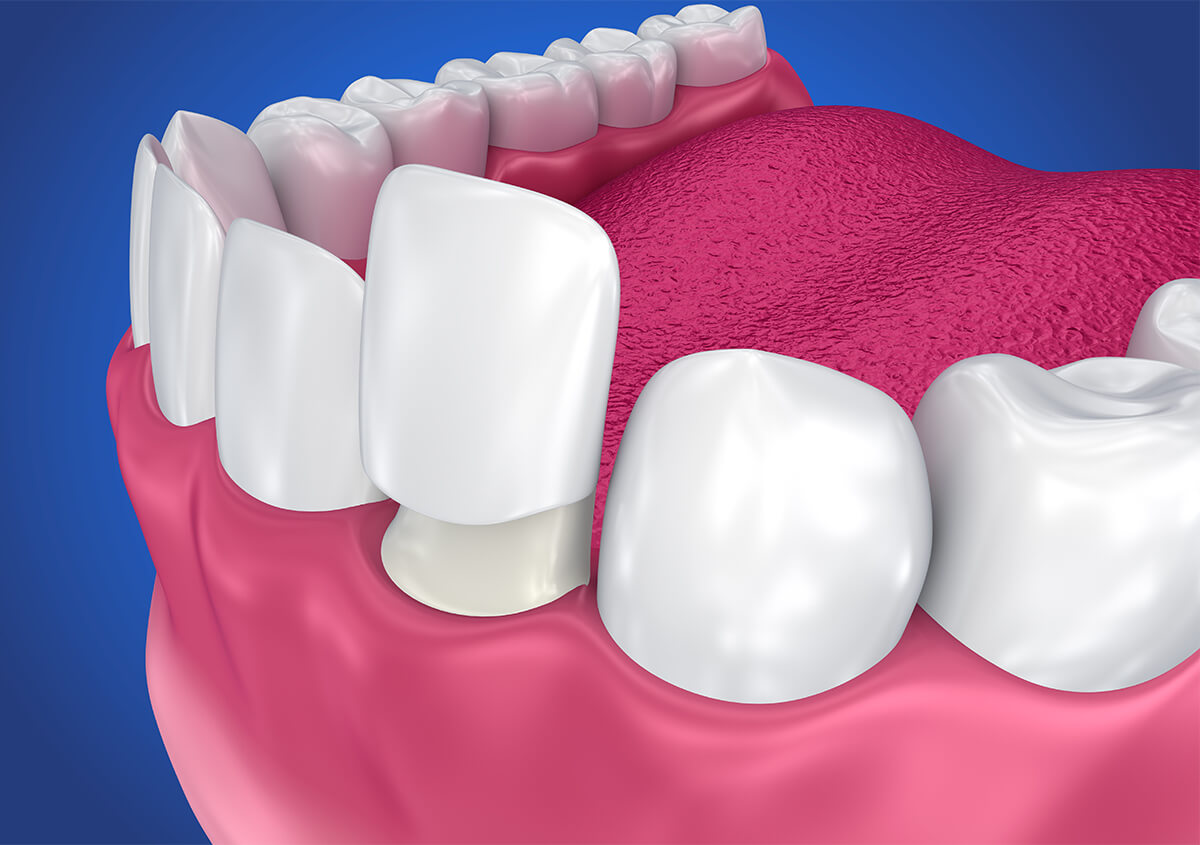 Teeth Veneers in West Bend WI Area